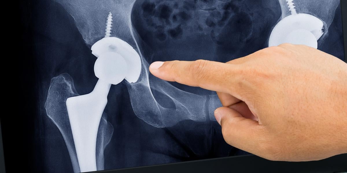 A magyar beteg sokáig csak interneten kerül protézis közelébe