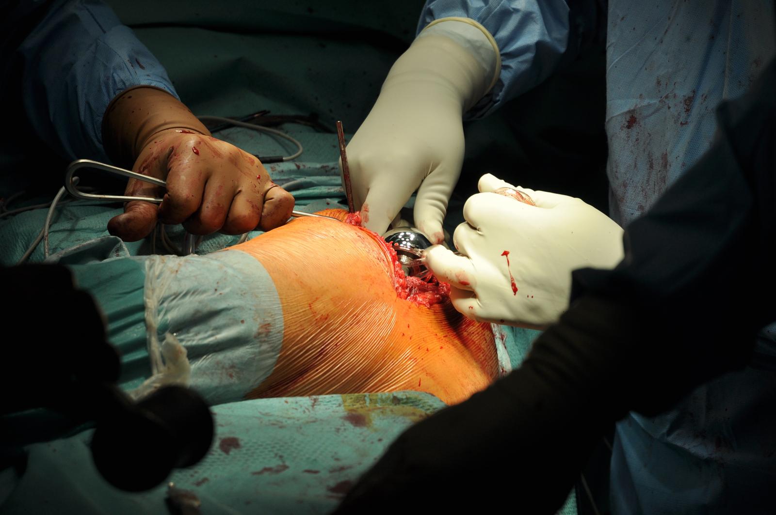 Csípőprotézis-műtét