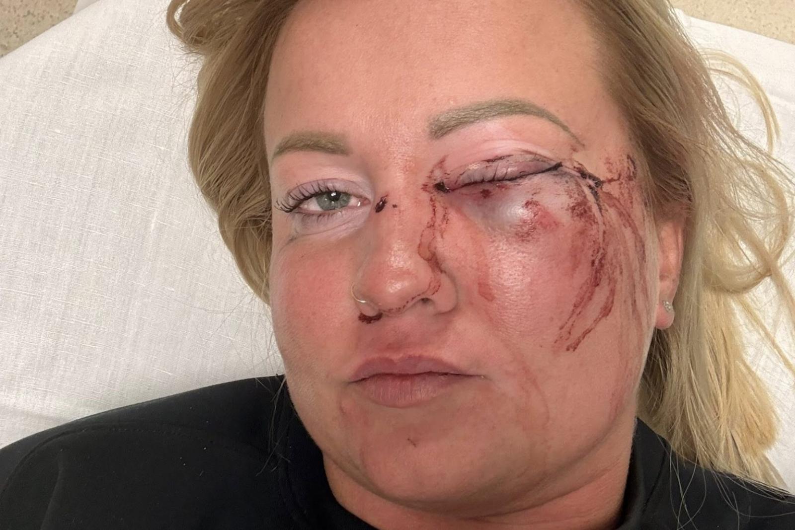 Úgy tűnik, politikai vita fajult brutális verésig, a szentmártonkátai alpolgármester által megütött nő az egyik szemére elvesztette a látását