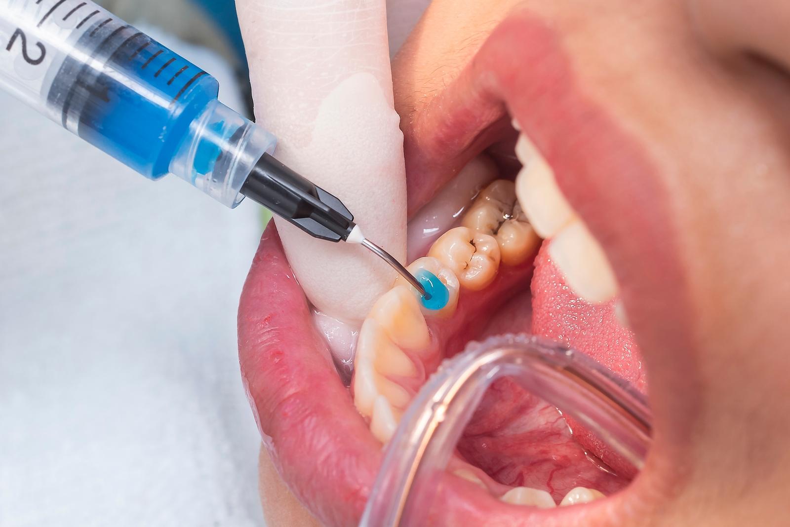 Tömés, implantátum, korona helyett jobb lenne a fognövesztés, de még messze van a megoldás