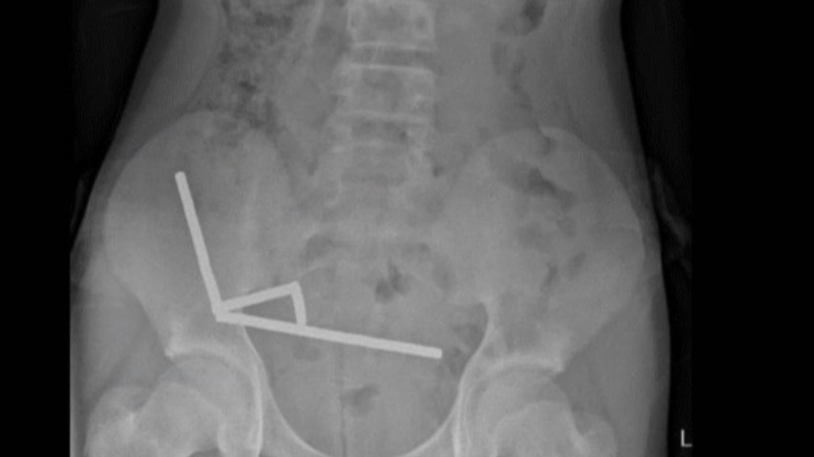Röntgenfelvételen az összetapadt mágnesek az új-zélandi tinédzser hasüregében.