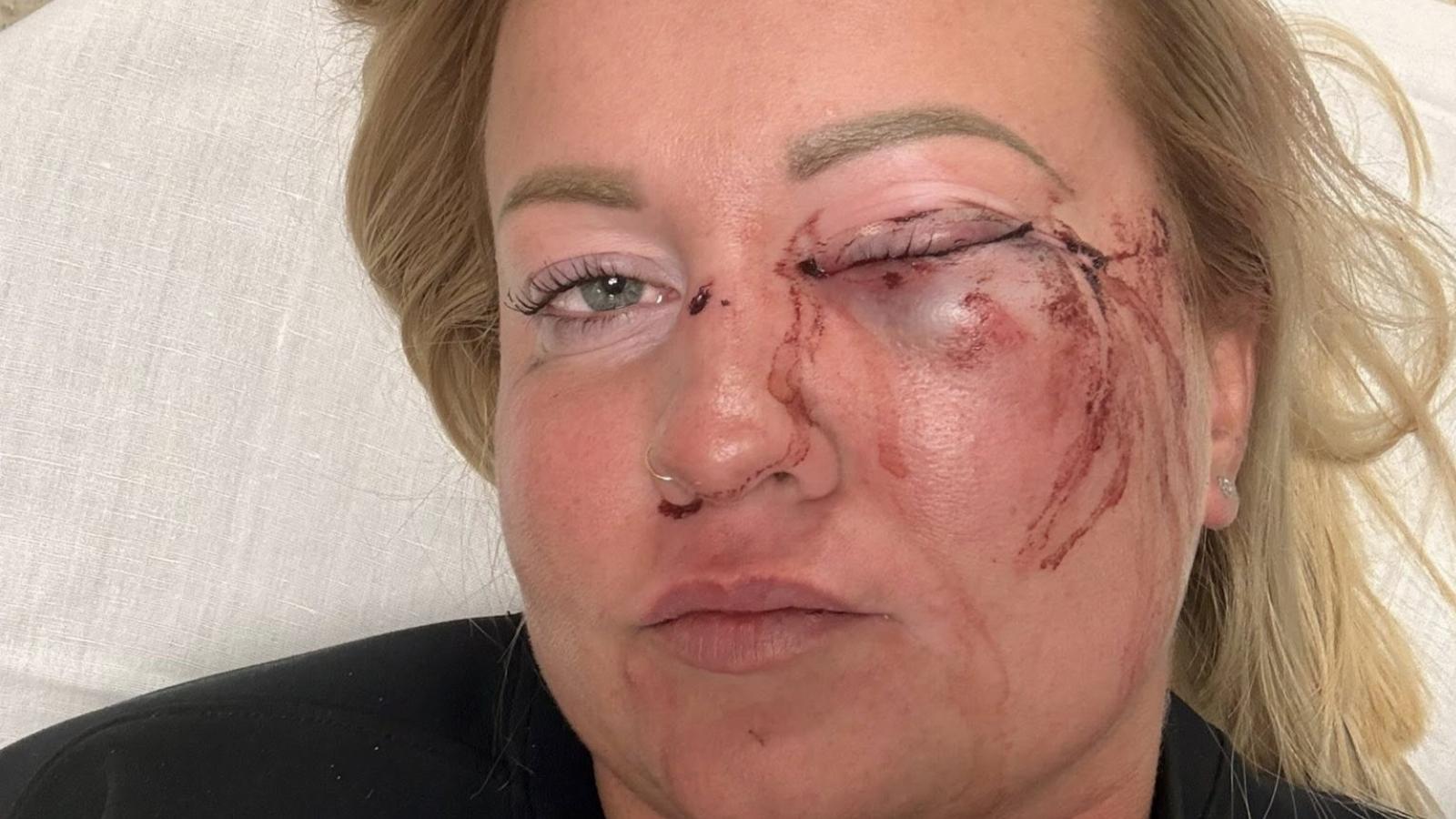 Úgy tűnik, politikai vita fajult brutális verésig, a szentmártonkátai alpolgármester által megütött nő az egyik szemére elvesztette a látását