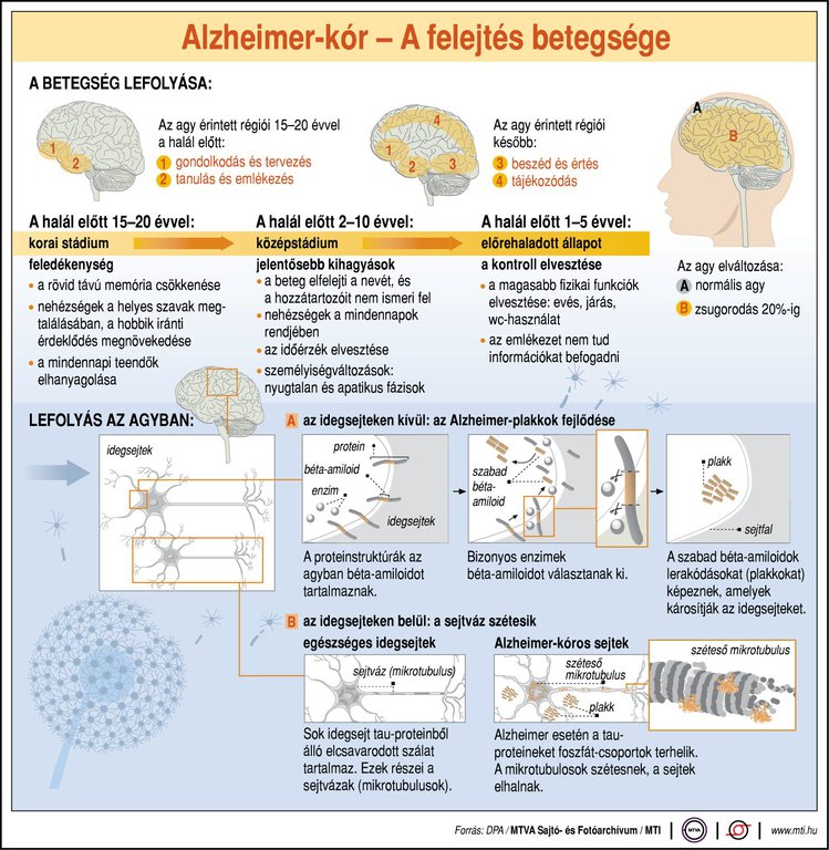 Az Alzheimer-kór a felejtés betegsége; az ábra a betegség lefolyását ismerteti. Forrás: MTI